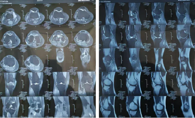 High-Power Laser Therapy for Osteoarthritis of the Knee（images 1）