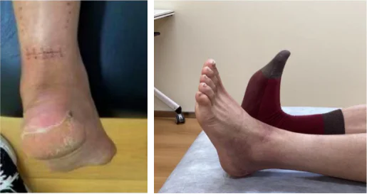 Postoperative Rehabilitation der Achillessehne mittels Lasertherapie der Klasse 4: Eine umfassende Fallstudie (Abbildung 1)
