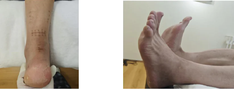 Postoperative Rehabilitation der Achillessehne mittels Lasertherapie der Klasse 4: Eine umfassende Fallstudie (Bilder 2)