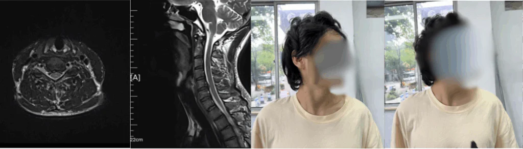 Terapia con láser de clase 4 para el dolor crónico de cuello y hombros en pacientes con espondilosis cervical (imagen 1)