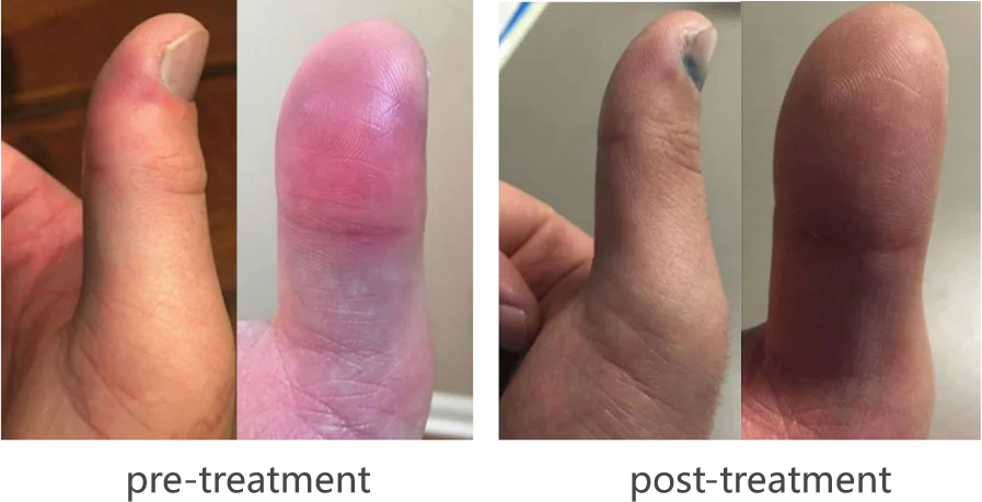 Guarigione accelerata delle fratture con la terapia laser di classe 4 (immagine 1)