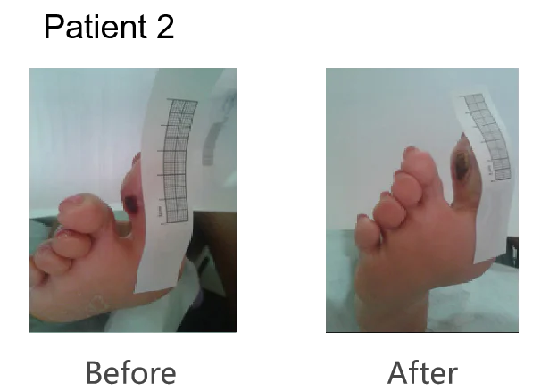 Advanced Class 4 Laser Therapy for Diabetic Foot Ulcers（images 2）