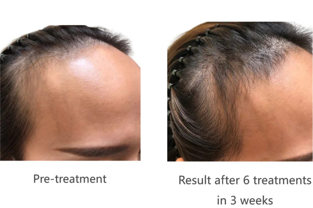 Postpartum Hair Loss Treatment Using Class 4 Laser Therapy: A Clinical Case Study(images 2)