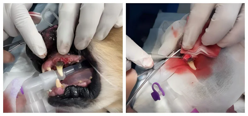 Case Sharing | Application of Class 4 Laser Therapy in Treating Gingival Hyperplasia with Chronic Inflammation（images 1）