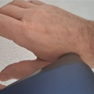 المعالجة السريرية المتقدمة لالتهاب المفاصل الجذري الثنائي...