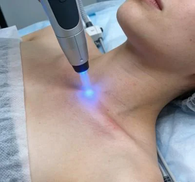 High Power Laser Integration for Recalcitrant Lumbar Disc Herniation and Radiculopathy(images 1)